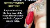 Tendon Ruptures Around The Shoulder - Everything You Need To Know - Dr. Nabil Ebraheim
