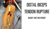 Distal biceps tendon rupture: Mechanism of injury and treatment