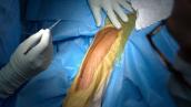 Repair of Humeral Shaft Nonunion with Plate and Screw Fixation and Iliac Crest Bone Graft