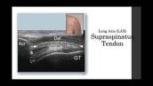 MSK Ultrasound Evaluation: Differentiation of Tendinopathy vs Tear in the Rotator Cuff