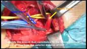 Contralateral C7 Nerve Transfer with Direct Coaptation to Restore Lower Trunk Function After...