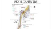 Nerve Transfers for Shoulder and Elbow Function (Feat. Dr. Mackinnon)