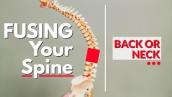 The Problem with Fusing Your Spine- Back or Neck