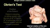 Biceps tendon  Injuries, Examinations \u0026 Tests - Everything You Need To Know - Dr. Nabil Ebraheim