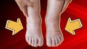 Top Causes Of Ankle Swelling \u0026 Pain (All You Need To Know)