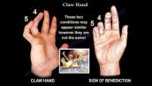 Claw Hand, Ulnar Claw Hand - Everything You Need To Know - Dr. Nabil Ebraheim