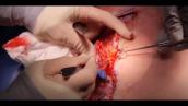 Brachial Plexus Infra-clavicular Anatomy: Live Dissection