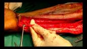 Surgery for brachial plexus injury - Contralateral C7 transfer