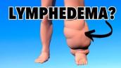 Do I Have Lymphedema vs. Swelling (What is the Difference)