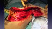 Video presentation 1 minute masterclass   Intercostal nerve transfers to the musculocutaneous nerve