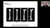 Distal Femoral Osteotomy: Indications, Planning and Surgical Technique