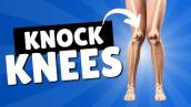Knock Knees - Corrective Exercises and Treatment for Genu Valgum