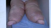 Lymph oedema clinical cases, Part 1