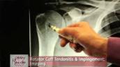 Rotator Cuff Impingement \u0026 Tendonitis Part 2: Symptoms \u0026 Evaluation