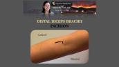 Distal Biceps Tendon Ruptures - Evaluation and Repair