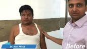 Brachial Plexus Injury Treatment in hindi | Brachial Plexus Surgery  Patient Review . Dr Amit Mittal