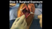 Tension Suture Fixation of Olecranon Fractures: Surgical Approach