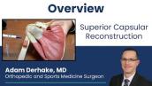Superior Capsular Reconstruction of the Shoulder (SCR): Overview
