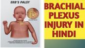Brachial plexus injury in hindi - Brachial plexus in hindi | Brachial plexus simplified