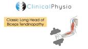 Classic Long Head of Biceps Tendinopathy | Clinical Physio