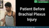brachial plexus patient before and after surgery Review | Brachial Plexus Injury Treatment