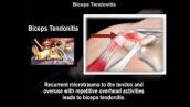 Biceps Tendonitis - Everything You Need To Know - Dr. Nabil Ebraheim