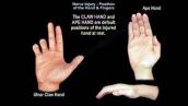 Nerve Injury Position of the Hand \u0026 Fingers - Everything You Need To Know - Dr. Nabil Ebraheim
