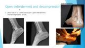 Foot and ankle 2 (insertional Achilles tendinosis)