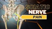 Top 3 Causes of Sciatic Nerve Pain: How to Tell What is Causing It.