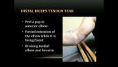 Distal Biceps Tendon Ruptures - Raffy Mirzayan, MD