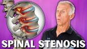 Top 3 Exercises For Spinal Stenosis