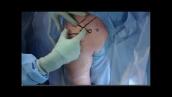 Rotator cuff surgery, explained by Ohio State Sports Medicine